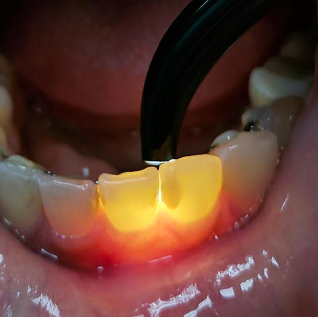 Melectio endolysspids 