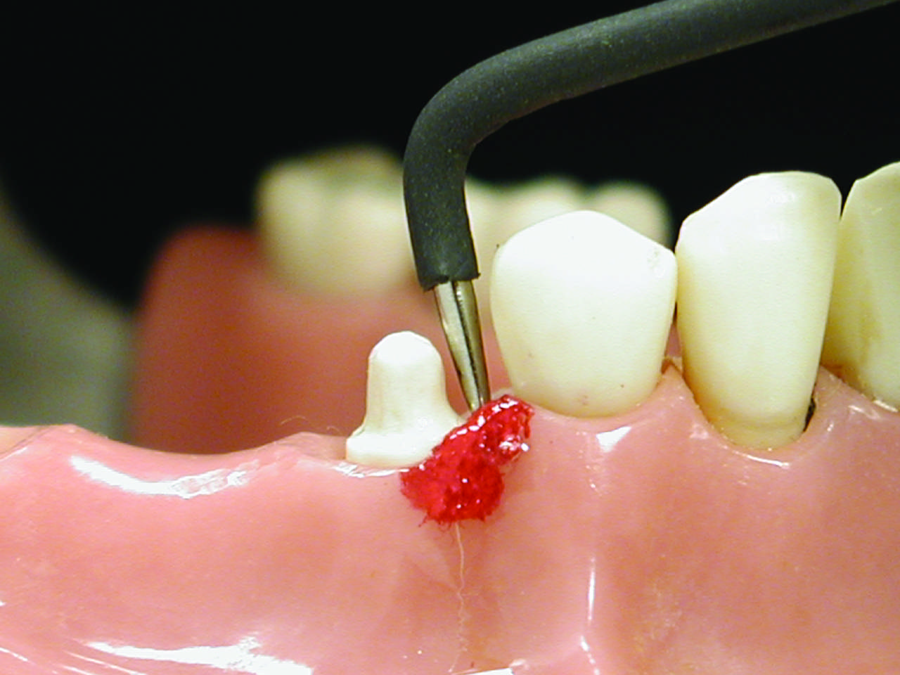 Elektrode P4 proxmimal hæmostase, til Sensimatic