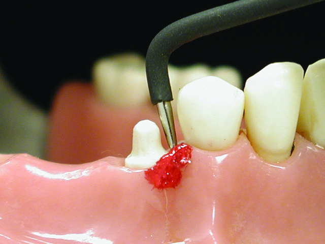 Elektrode P4 proxmimal hæmostase, til Sensimatic